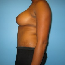 25-34 year old woman treated with Mommy Makeover after 3293500