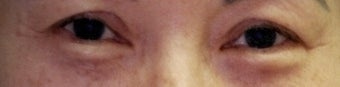 Revision Bilateral Asian Eyelid Surgery before 861226