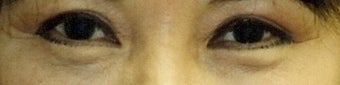 Revision Bilateral Asian Eyelid Surgery after 861226