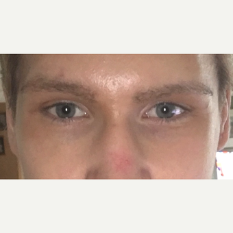 27 year old, with inherited droopy lower eyelids with sclera show, underwent Almond Eye Surgery. after 3789524