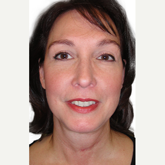48 year old woman treated with lower blepharoplasty + fat removal after 2870075