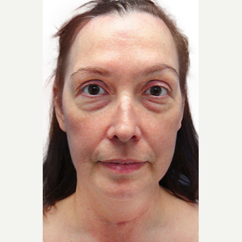 48 year old woman treated with lower blepharoplasty + fat removal before 2870075