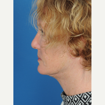 57 year old woman treated with a deep plane Facelift after 3466627