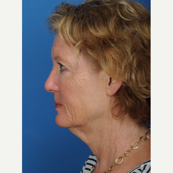 57 year old woman treated with a deep plane Facelift before 3466627
