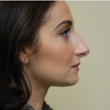 25-34 year old woman treated with Rhinoplasty before 3506046