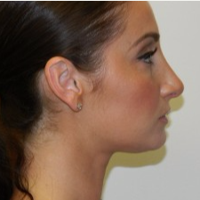 25-34 year old woman treated with Rhinoplasty after 3506046