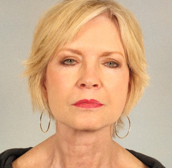 68-year-old Female Facelift, Necklift, Quad Blepharoplasty after 1454310