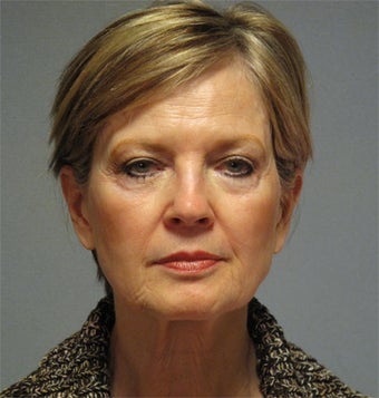 68-year-old Female Facelift, Necklift, Quad Blepharoplasty before 1454310