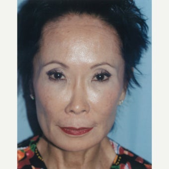 Dr. Lu-Jean Feng combines treatments to effectively stimulate collagen production before 2278684