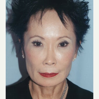 Dr. Lu-Jean Feng combines treatments to effectively stimulate collagen production after 2278684