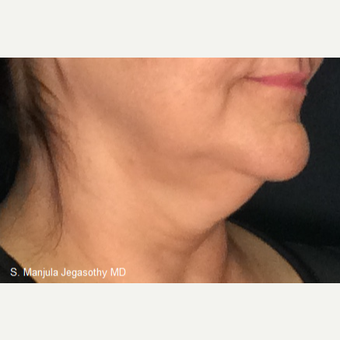 Immediate Non-Surgical Neck Lift with Ultherapy before 3656337