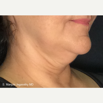 Immediate Non-Surgical Neck Lift with Ultherapy after 3656337