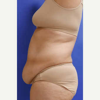 55-64 year old woman treated with Tummy Tuck before 3165594