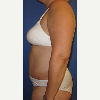 55-64 year old woman treated with Tummy Tuck after 3165594