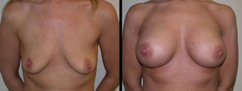 Breast Augmentation before 1231581