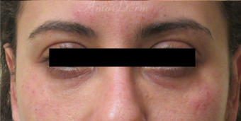 35-44 year old woman treated with Restylane after 3835936