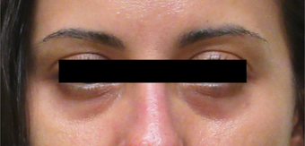 35-44 year old woman treated with Restylane before 3835936