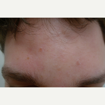 Peels for acne can be effective. after 3731853