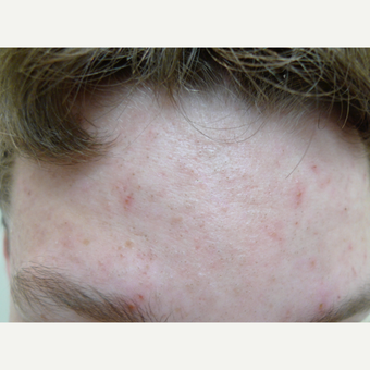 Peels for acne can be effective. before 3731853