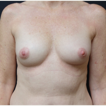 35-44 year old woman treated with Mentor Breast Implants before 3280315