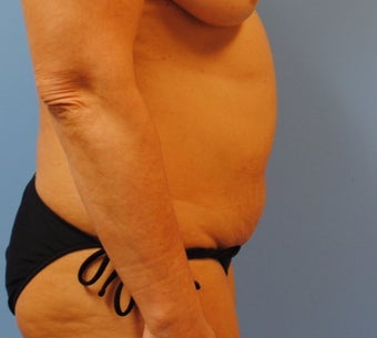 48 year old woman treated with Tummy Tuck before 3208155