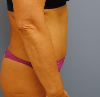 48 year old woman treated with Tummy Tuck after 3208155