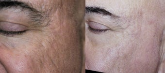 65-74 year old man treated with Acne Scars Treatment before 3278125