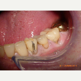 Dental Crowns - Cerac before 2654487