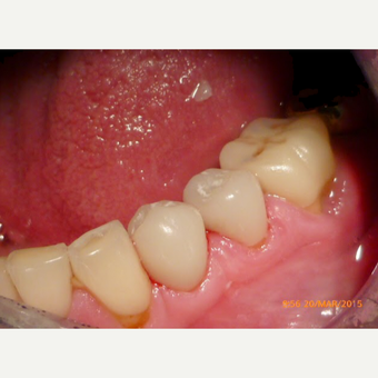 Dental Crowns - Cerac after 2654487
