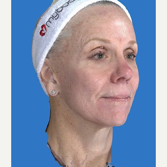 59 year old woman treated with Laser Resurfacing before 3839801