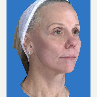 59 year old woman treated with Laser Resurfacing after 3839801
