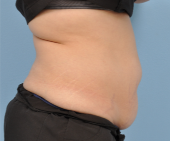 35-44 year old woman treated with CoolSculpting before 3802068