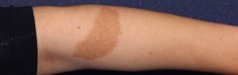 25-34 year old man treated with Laser Treatment before 3623888