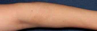 25-34 year old man treated with Laser Treatment after 3623888