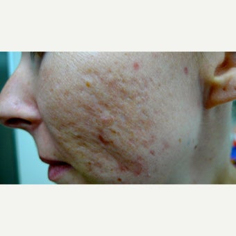 Fractional and fully ablative lasers for acne scars before 1751341