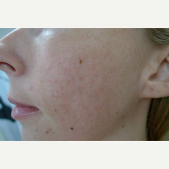 Fractional and fully ablative lasers for acne scars after 1751341