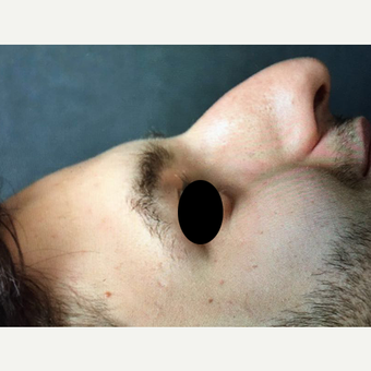 18-24 year old man treated with Rhinoplasty before 3211739
