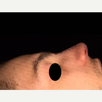 18-24 year old man treated with Rhinoplasty after 3211739