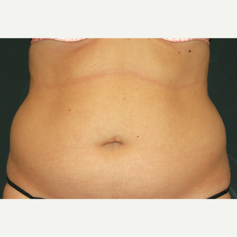 35-44 year old woman treated with Liposculpture before 3650050