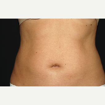 35-44 year old woman treated with Liposculpture after 3650050