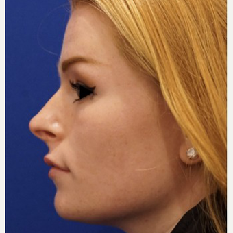 18-24 year old woman treated with Non Surgical Nose Job after 3711456