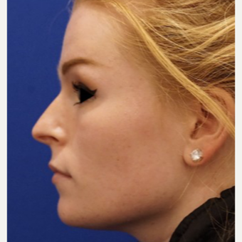 18-24 year old woman treated with Non Surgical Nose Job before 3711456