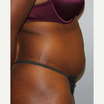 25-34 year old woman treated with Liposuction before 3564628