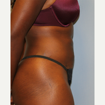 25-34 year old woman treated with Liposuction after 3564628