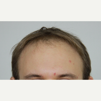 FUE Hair Transplant result 3,500 grafts before 3616827