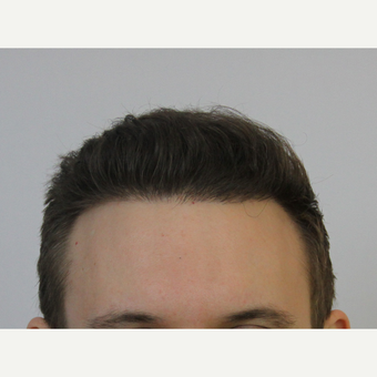 FUE Hair Transplant result 3,500 grafts after 3616827