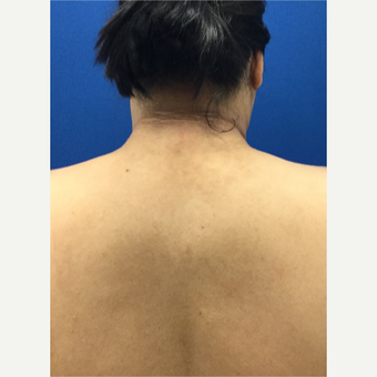 Laser Liposuction of 'Buffalo Hump' after 3259340