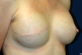 45-54 year old woman treated with Breast Reconstruction after 1675786