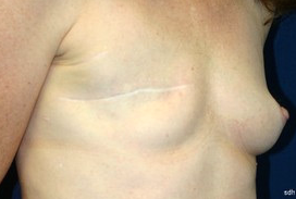 45-54 year old woman treated with Breast Reconstruction before 1675786