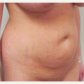 Tummy Tuck for this 31 Year Old Woman before 3092490